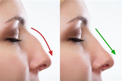 Nose Magic: Empowering People to Embrace Their Unique Features